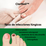ClariNail™ – Tratamiento Antihongos de Uñas con Resultados Visibles - ClickBag