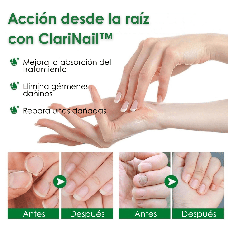 ClariNail™ – Tratamiento Antihongos de Uñas con Resultados Visibles - ClickBag