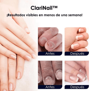 ClariNail™ – Tratamiento Antihongos de Uñas con Resultados Visibles - ClickBag