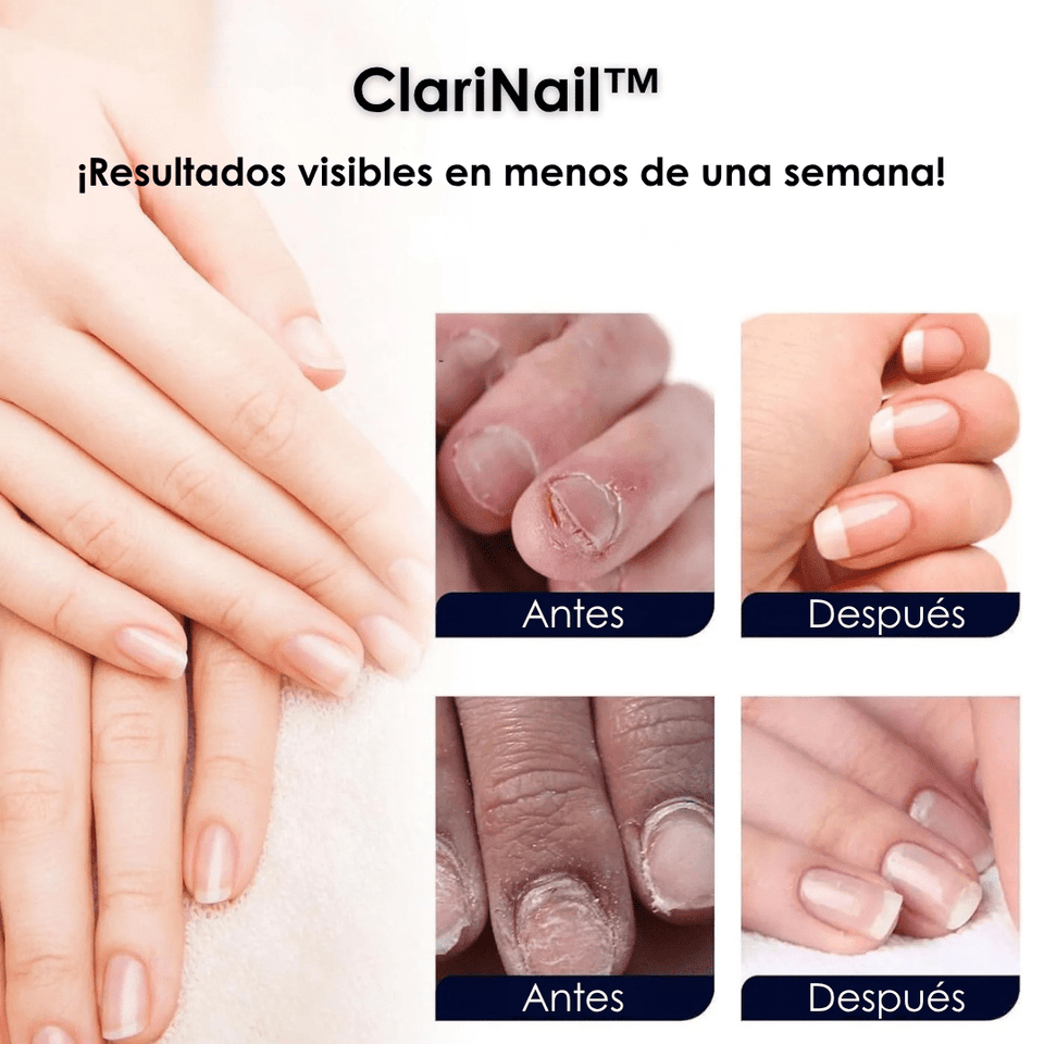 ClariNail™ – Tratamiento Antihongos de Uñas con Resultados Visibles - ClickBag